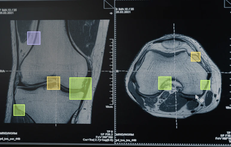 An MRI scan of a knee with bounding box annotations, showcasing Objectways' expert medical imaging services for healthcare AI.