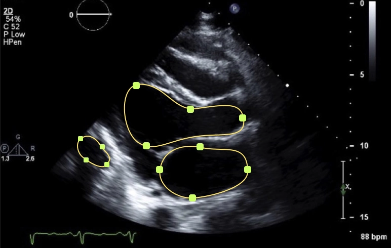An echocardiogram with precise polygon annotations of heart chambers, showcasing Objectways' expert medical imaging services.